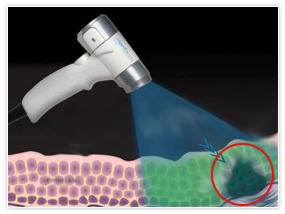 口腔がんチェック