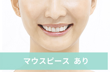 インビザライン04