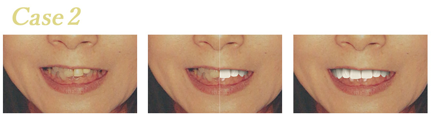 シュミレーションソフト治療後イメージ02