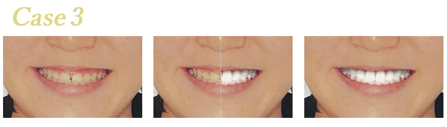 シュミレーションソフト治療後イメージ03