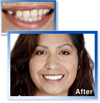 スナップオンスマイル