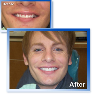 スナップオンスマイル