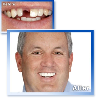 スナップオンスマイル