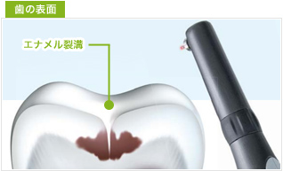 虫歯ディテクター(虫歯探知機)