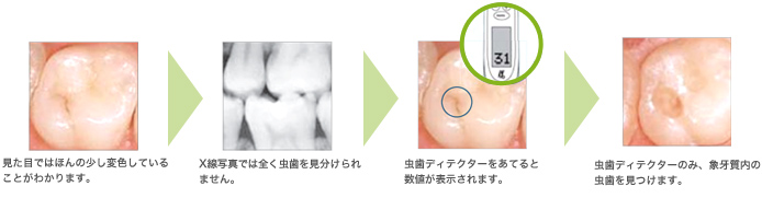 虫歯ディテクター(虫歯探知機)