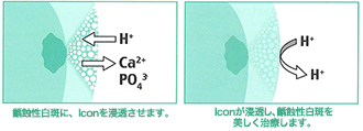 ICONを齲蝕部分に浸透させ美しく治療
