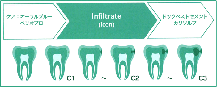 Icon虫歯進行状態
