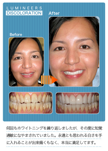 何回もホワイトニングを繰り返しましたが、その度に知覚過敏になやまされていました。永遠とも思われる白さを手に入れることが出来、痛くもなく、本当に満足しています。