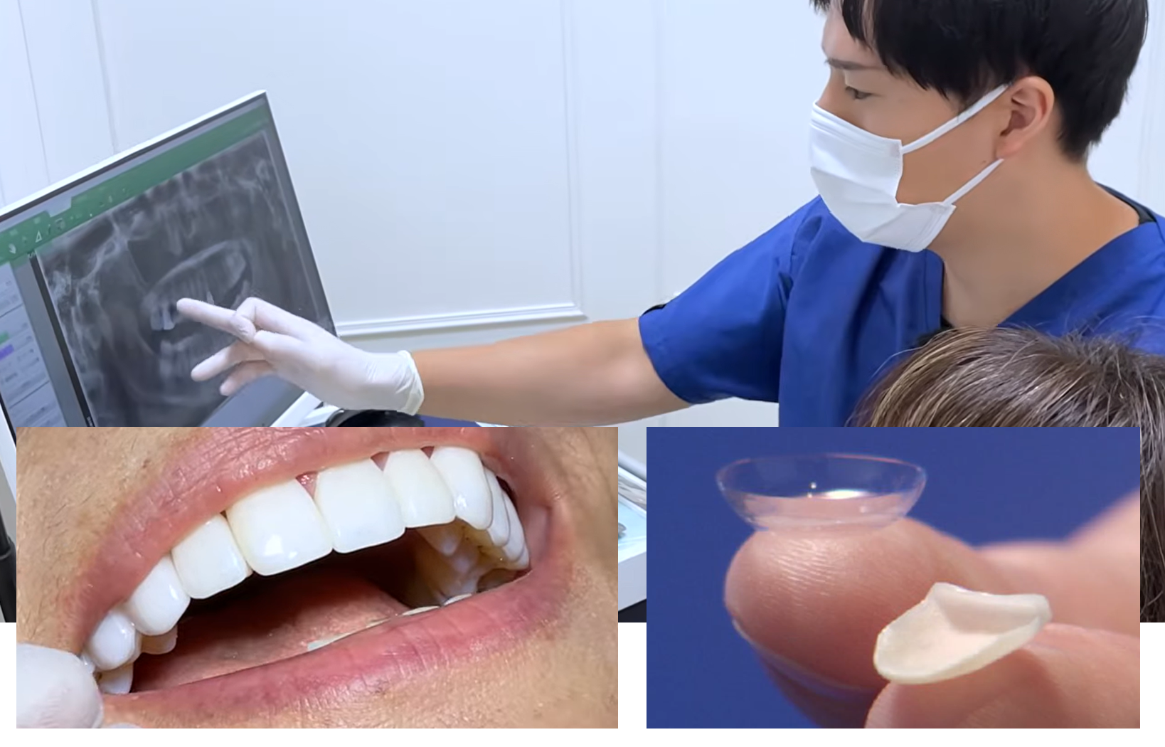 ルミネアーズは歯をほぼ削らずに薄いセラミックを貼るだけ