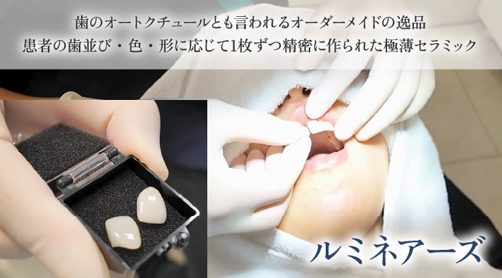 ルミネアーズ独自のポーセレンとウルトラボンドの組み合わせにより耐久性と美しさを実現!