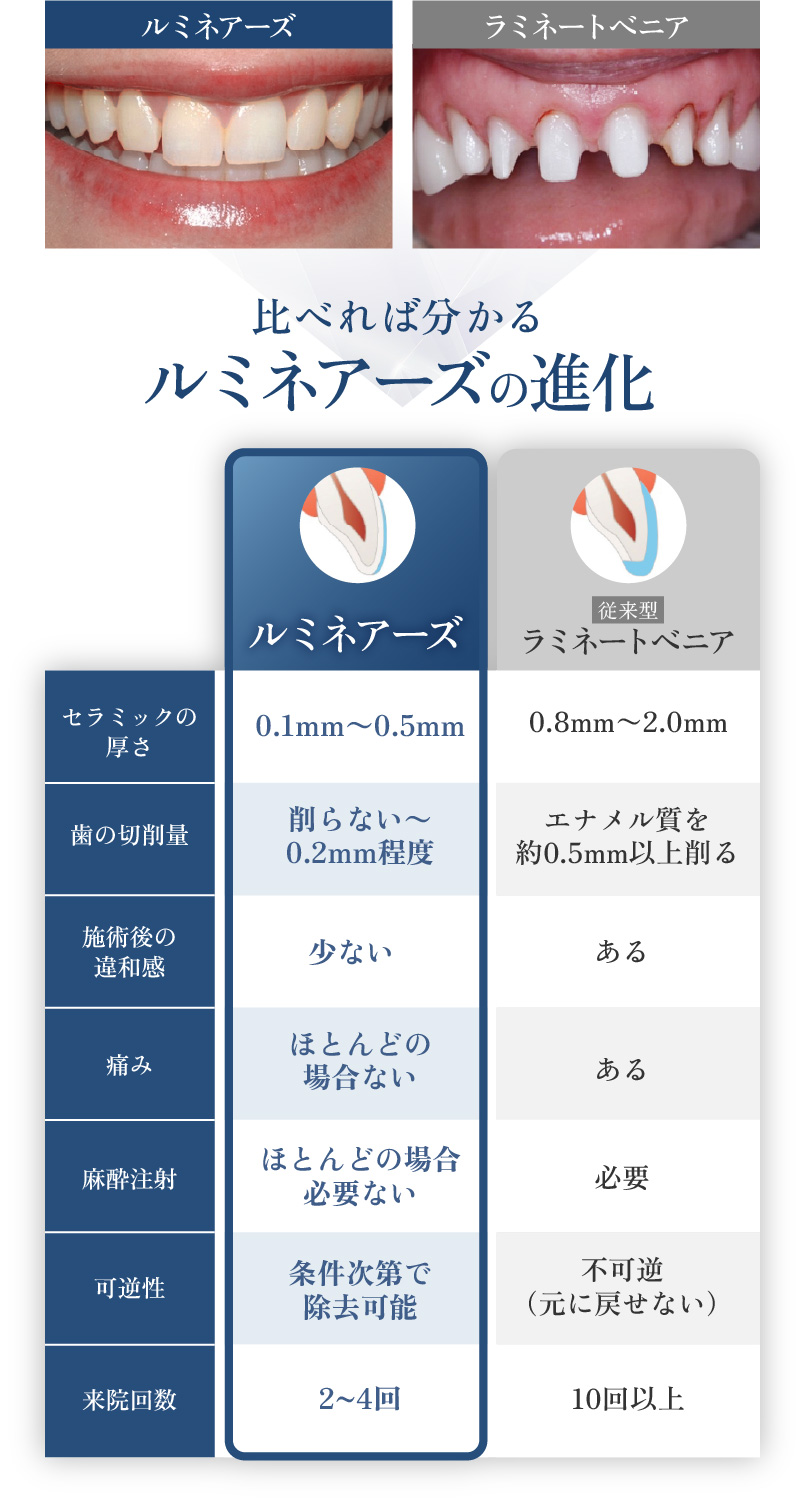比べれば分かるルミネアーズの進化 ルミネアーズは歯をほとんど削らず痛みもほとんどの場合ありません