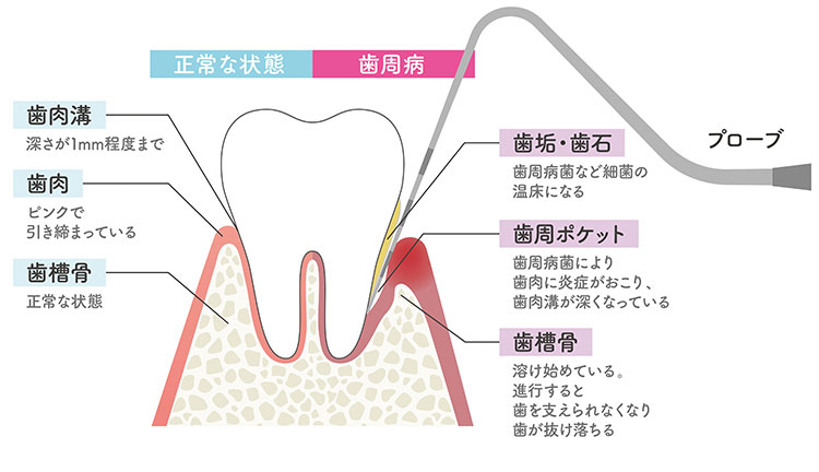 正常な状態の歯と歯周病の歯