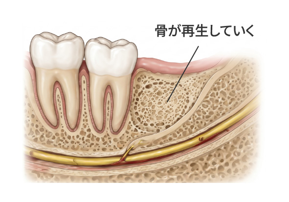 骨が再生していく