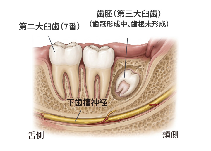 埋伏している親知らずの歯胚