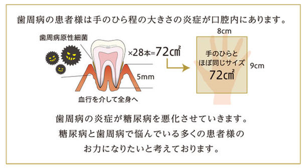 歯周病の患者様は手のひら程の大きさの炎症が口腔内にあります。