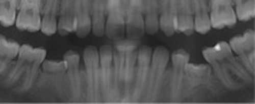 乳臼歯の咬合下_図5