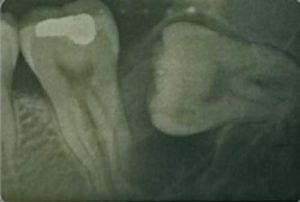 口および顎領域の嚢胞
