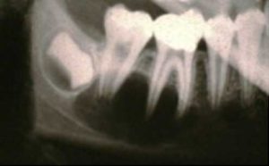 口および顎領域の嚢胞