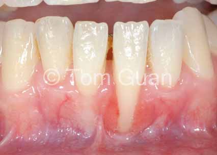 歯肉退縮の治療原則_図1-1