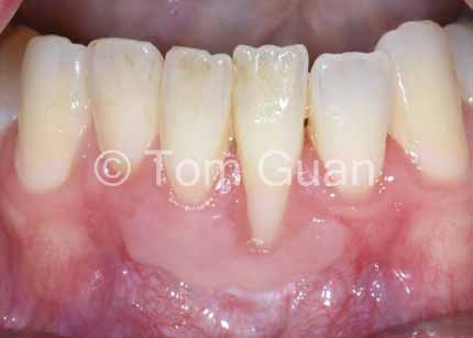 歯肉退縮の治療原則_図1-2