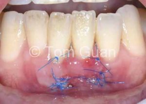 歯肉退縮の治療原則_図1-3