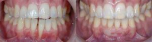 歯肉退縮の治療原則_図1-4