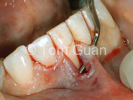歯肉退縮の治療原則_図2-1
