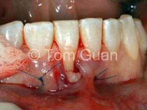 歯肉退縮の治療原則_図2-2