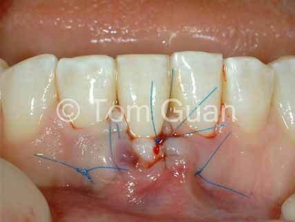 歯肉退縮の治療原則_図2-3