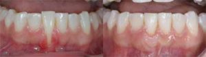 歯肉退縮の治療原則_図2-4