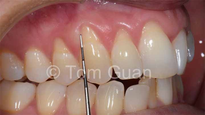 歯肉退縮の治療原則_図3-1