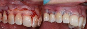 歯肉退縮の治療原則_図3-2