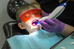 虫歯発掘のためのレーザー治療