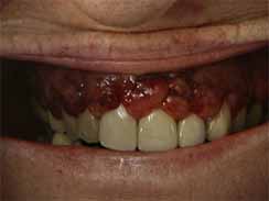 口腔がんと悪性腫瘍の兆候