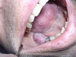 口腔がんと悪性腫瘍の兆候