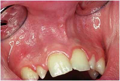 口腔粘膜のタバコ関連の変化_図6