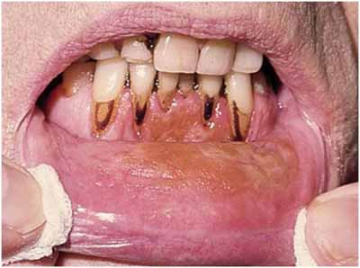 口腔粘膜のタバコ関連の変化_図8