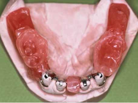 義歯の顎登録_図3