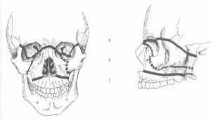中間の顔面骨折-ルフォー骨折（上顎）_図1
