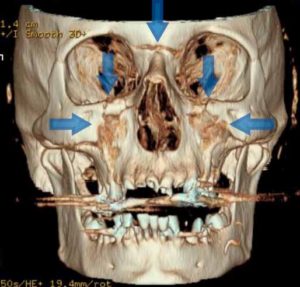 中間の顔面骨折-ルフォー骨折（上顎）_図3