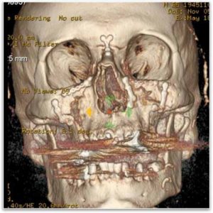中間の顔面骨折-ルフォー骨折（上顎）_図4
