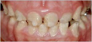 アメロジェネシス不完全-補綴治療_図6