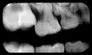 上顎-6の異所性発疹_図2
