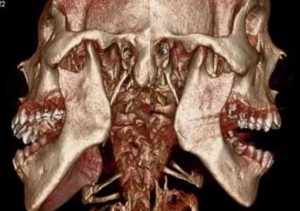 エミネクトミー（結核関節の外科的縮小）_図1