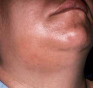 急性口腔感染症の外科的ドレナージ_図3