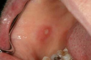 口内炎および口内炎様潰瘍_図1