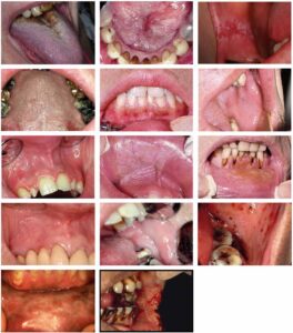口腔粘膜の変化の画像ギャラリー_図11
