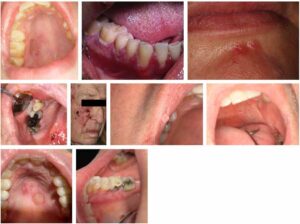 口腔粘膜の変化の画像ギャラリー_図14