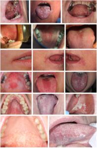 口腔粘膜の変化の画像ギャラリー_図15