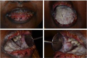 口腔粘膜の変化の画像ギャラリー_図18